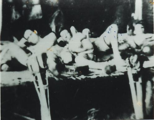 amputation hut - tarsau siam 1943